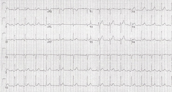 Initial ECG of a 21-year-old male with right-sided chest pain showing diffuse ST elevation