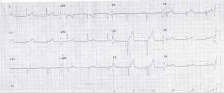 Summary of ECG changes in left-sided and right-sided pneumothorax