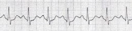 Initial ECG of a 95-year-old woman showing narrow-complex regular tachycardia at 144 bpm