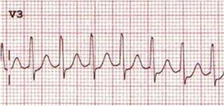 Reference ECG examples comparing sinus tachycardia, SVT and atrial flutter with fixed block