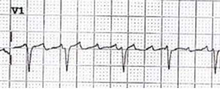 ECG showing a single wave between QRS complexes that could be read as a P wave or a T wave