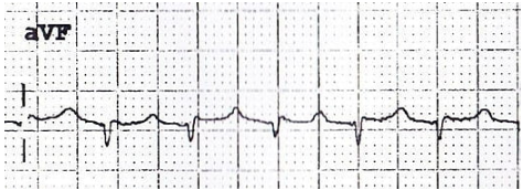 Illustration of the Bix Rule: a P-like wave midway between QRS complexes with hidden flutter waves