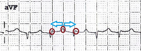 ECG with flutter waves marked, consistent with atrial flutter with 2:1 block