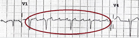 Post-treatment ECG showing classic flutter waves in V1 with variable block