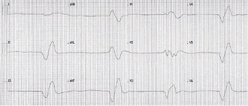 Initial ECG of a 69-year-old man showing bradycardia with very broad QRS complexes and sine wave morphology