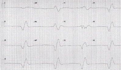 ECG with sine wave appearance in hyperkalemia, K+ 8.2 mmol/L