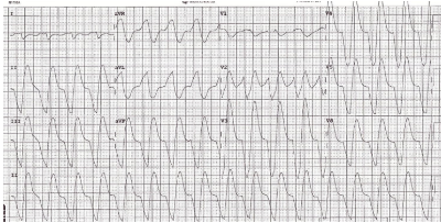 ECG of broad complex tachycardia mimicking ventricular tachycardia in hyperkalemia, K+ 7.8 mmol/L