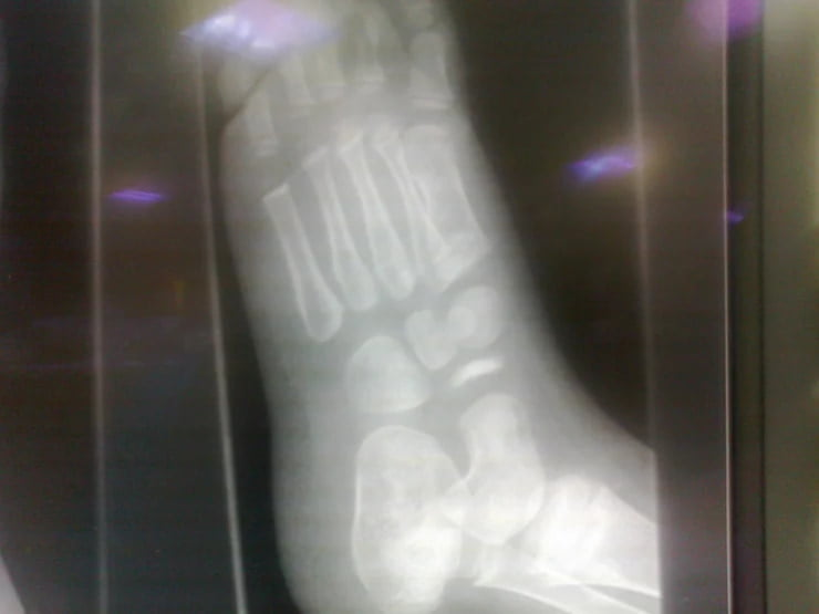 X-ray of the left foot of a 4-year-old boy showing a small, sclerotic and fragmented navicular bone