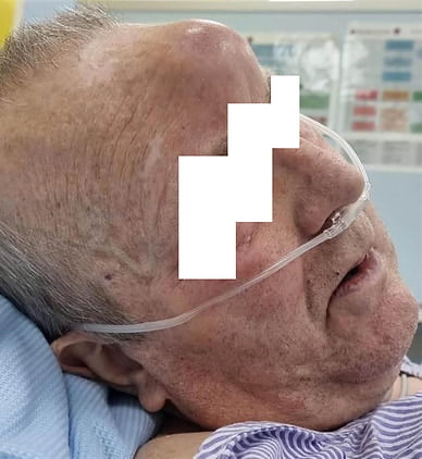 Photo of a forehead swelling in a 69-year-old man with recurrent sinusitis