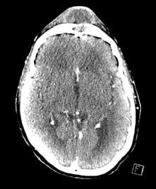 CT scan of the head showing frontal bone osteomyelitis with a subperiosteal abscess