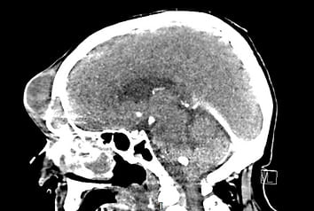 CT scan of the head showing frontal sinus involvement and subperiosteal collection in Pott's puffy tumour