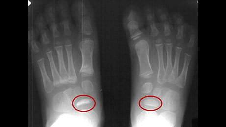 Comparison between a normal navicular bone and a necrotic navicular bone in Köhler disease
